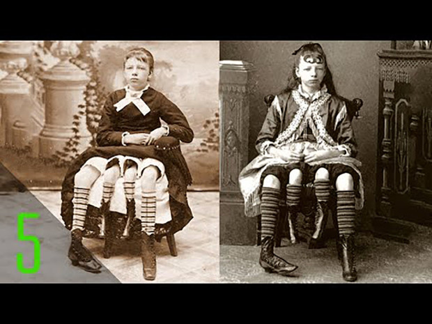 5 Most Incredible Sideshow Freaks Part 2